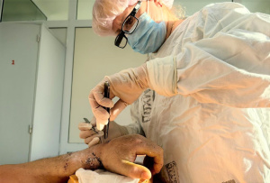 Держалась на одном кожном лоскуте. В Сургутской травмбольнице успешно выполнили реплантацию кисти после травматической ампутации