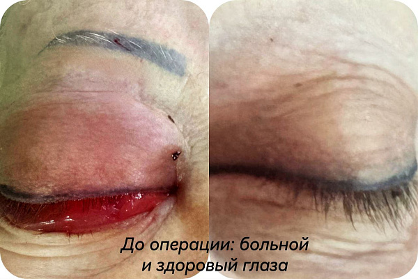 В Сургутской травмбольнице впервые применили уникальный и технический сложный трансорбитальный доступ для устранения опасной сосудистой аномалии