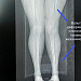 Второй шанс родному суставу. В Сургутской травмбольнице пациентку избавили от болей в колене без эндопротезирования