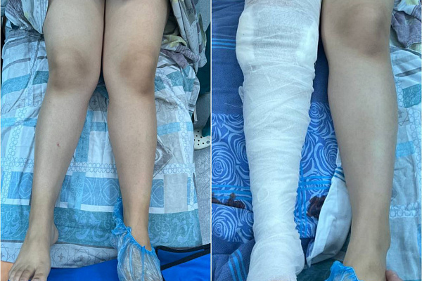 В Сургутской травмбольнице увеличивают объёмы высокотехнологичного лечения деформаций конечностей у детей 