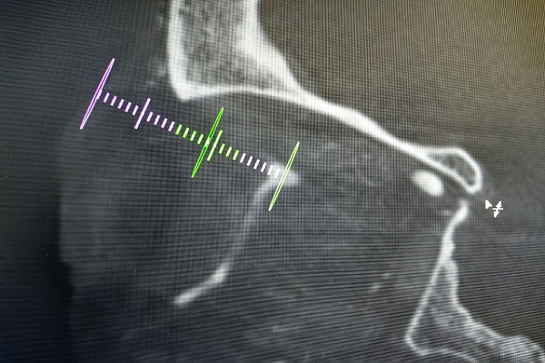 В Сургутской травмбольнице впервые применили уникальный и технический сложный трансорбитальный доступ для устранения опасной сосудистой аномалии