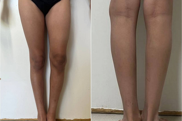 В Сургутской травмбольнице увеличивают объёмы высокотехнологичного лечения деформаций конечностей у детей 