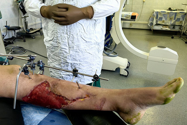 В Сургутской травмбольнице пациенту успешно провели этапное лечение тяжелой травмы нижней конечности после падения полуторатонной конструкции 