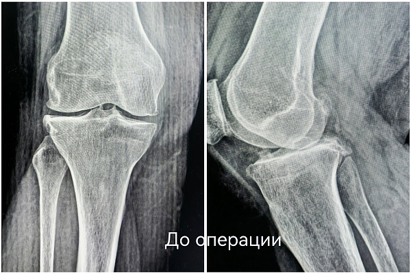 Второй шанс родному суставу. В Сургутской травмбольнице пациентку избавили от болей в колене без эндопротезирования
