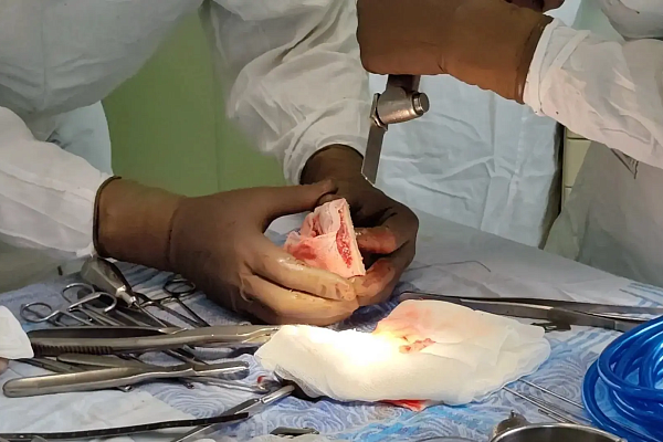 Сургутские травматологи-ортопеды восстановили бойцу СВО локтевую кость с помощью трансплантата на сосудистой ножке