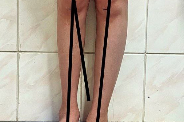 В Сургутской травмбольнице увеличивают объёмы высокотехнологичного лечения деформаций конечностей у детей 