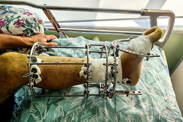 Строил баню – едва не остался инвалидом. В Сургутской травмбольнице экстренно спасали ногу мужчине, поранившемуся болгаркой