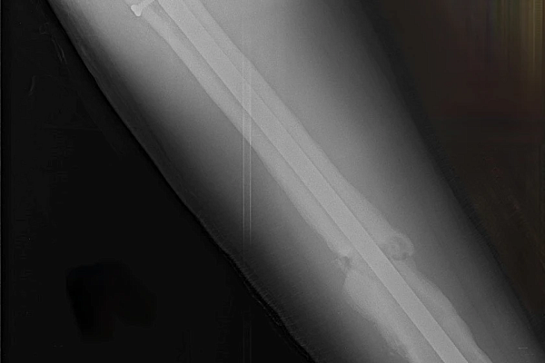 Уже не дети, но ещё не взрослые. Об особенностях лечения травм в подростковом возрасте