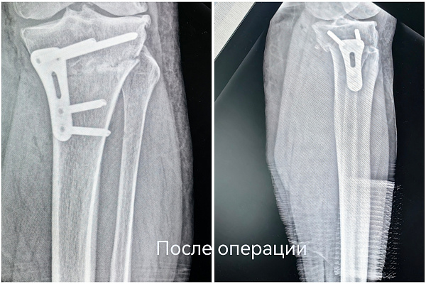 Второй шанс родному суставу. В Сургутской травмбольнице пациентку избавили от болей в колене без эндопротезирования