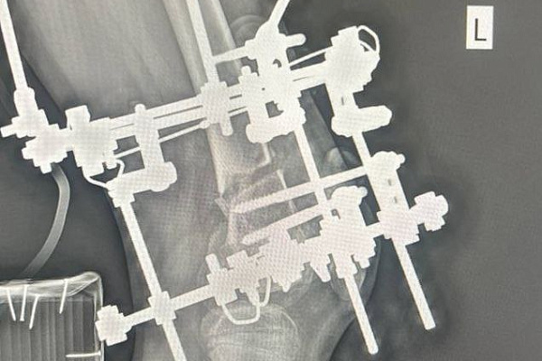 В Сургутской травмбольнице увеличивают объёмы высокотехнологичного лечения деформаций конечностей у детей 