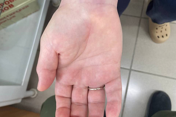 В Сургутской травмбольнице  начали выполнять уникальные для Югры малоинвазивные вмешательства при карпальном туннельном синдроме 