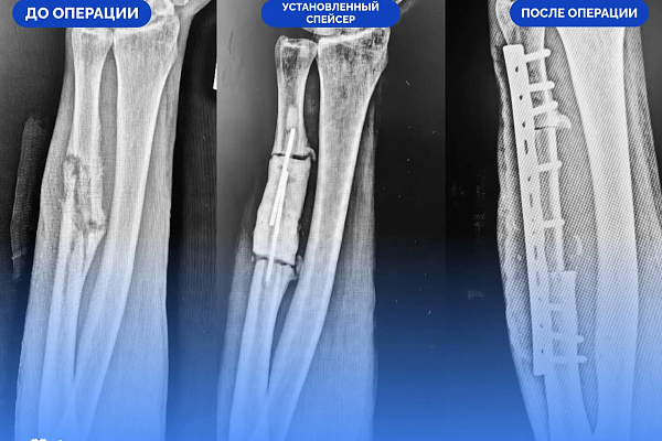 Сургутские травматологи-ортопеды восстановили бойцу СВО локтевую кость с помощью трансплантата на сосудистой ножке