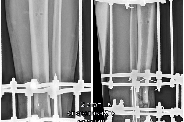 Строил баню – едва не остался инвалидом. В Сургутской травмбольнице экстренно спасали ногу мужчине, поранившемуся болгаркой